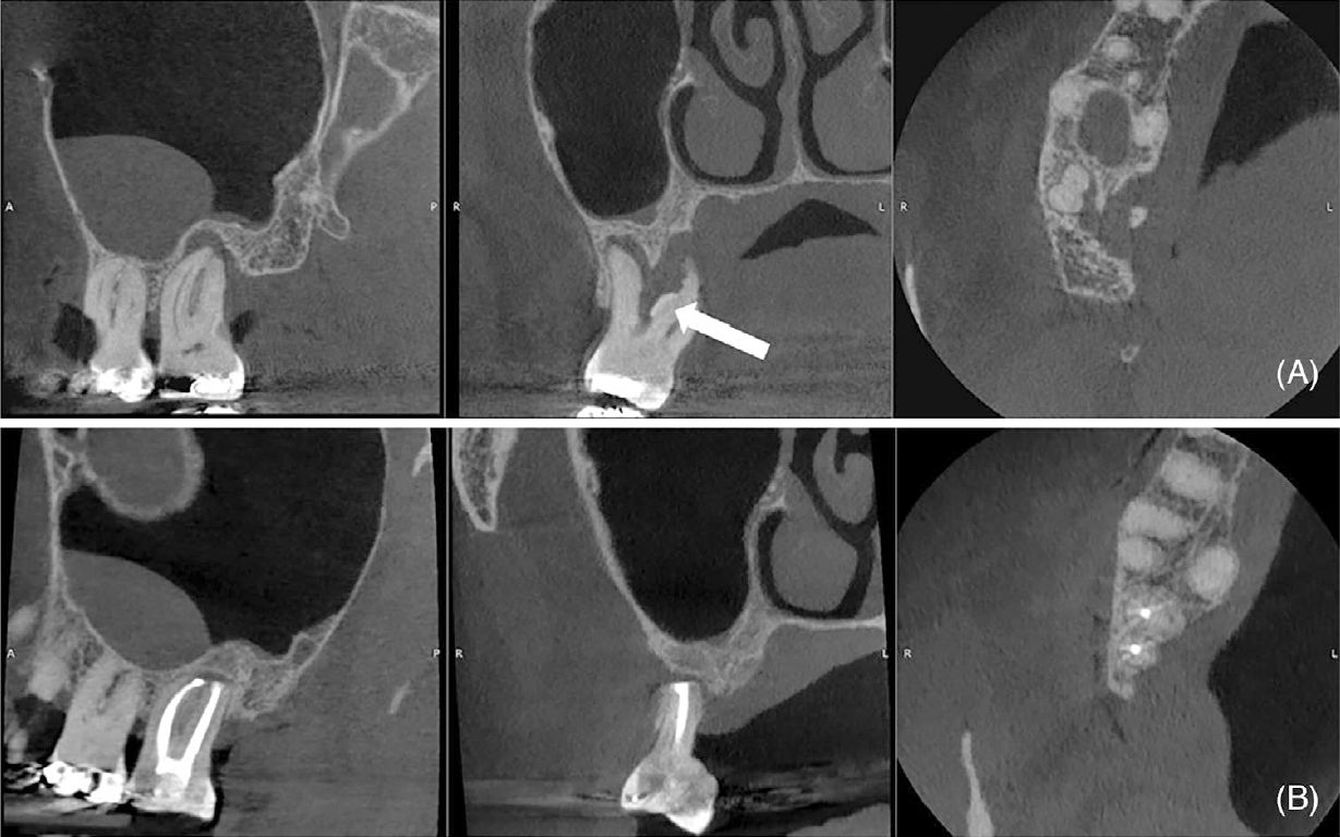 Исходное КТ зуба 17 (сагиттальная, корональная и аксиальная проекции)