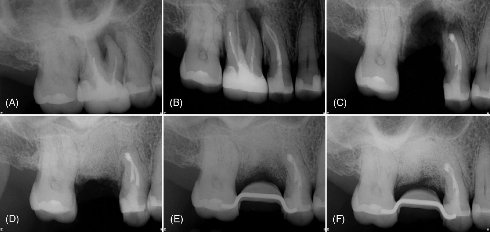 Периапикальная рентгенограмма, демонстрирующая поражение, вовлекающее зубы 16 и 15