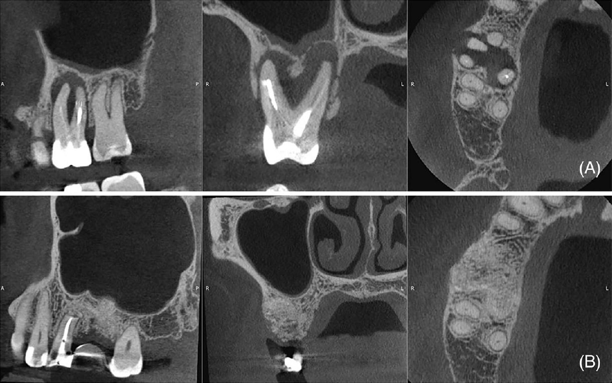 Исходное КТ (сагиттальная, корональная и аксиальная проекции), демонстрирующее очаг пониженной плотности вокруг зубов 16 и 15