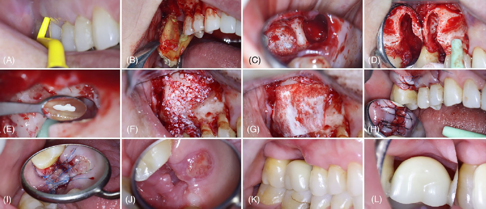 Предоперационный вид со щёчной стороны зуба 16