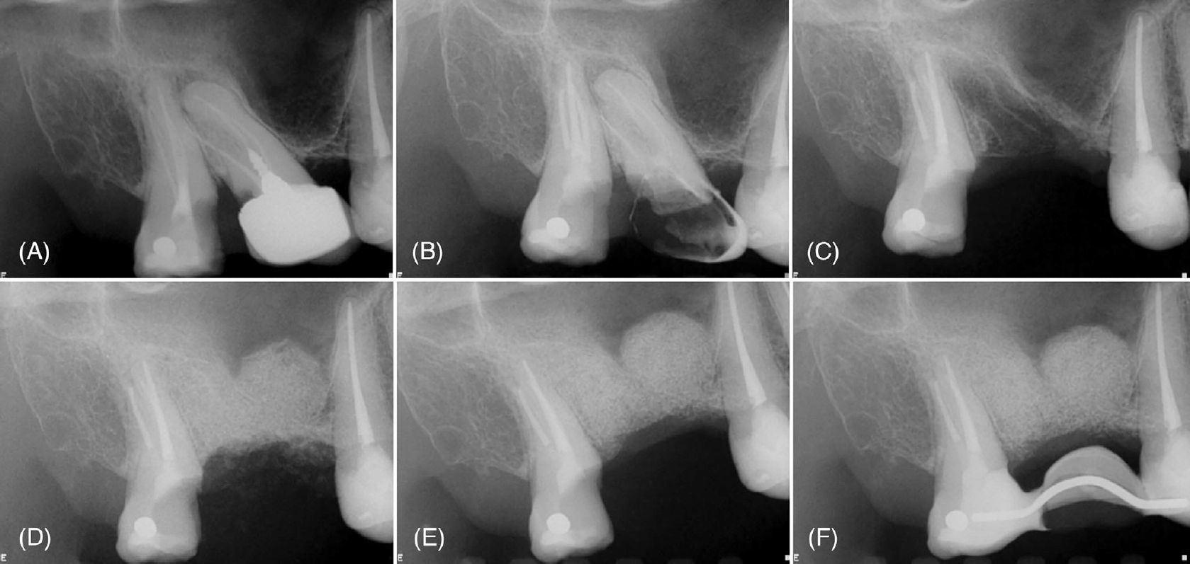 Периапикальная рентгенограмма с рентгенопрозрачным очагом в периапикальной области зубов 18 и 17