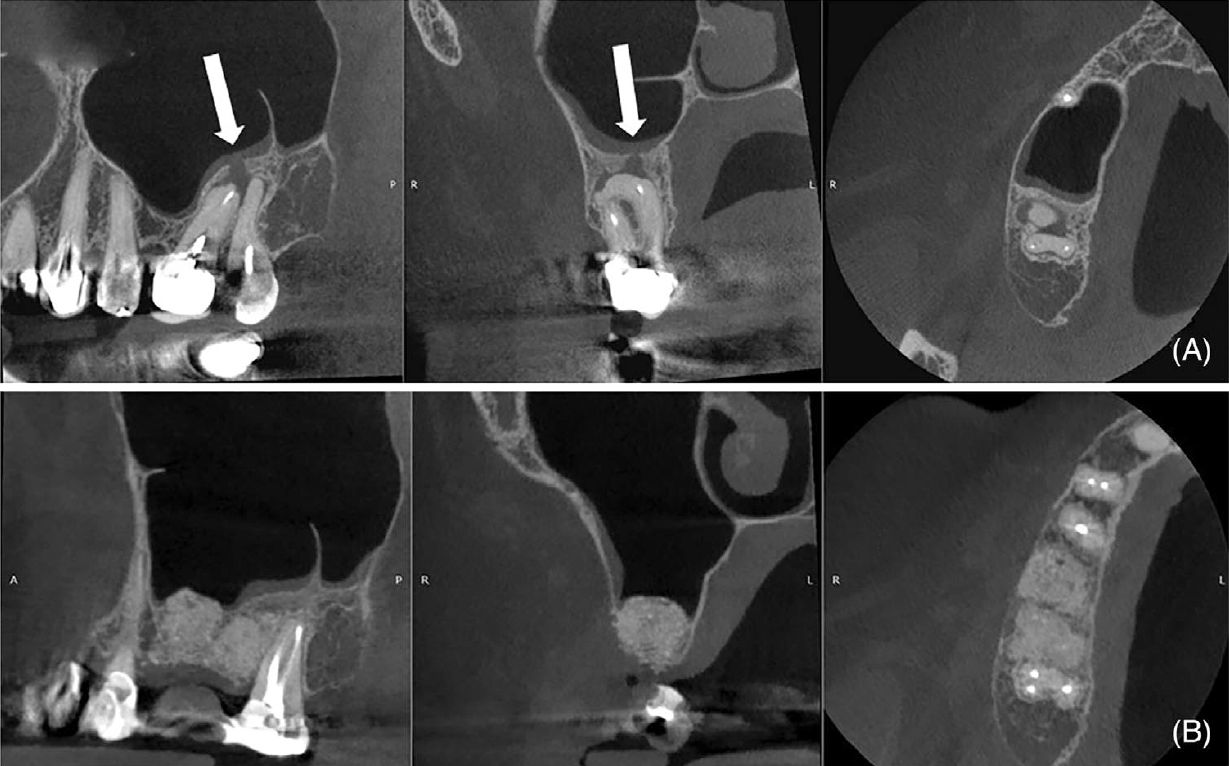 Исходное КТ (сагиттальная, корональная и аксиальная проекции), демонстрирующее очаг пониженной плотности в области зубов 18 и 17