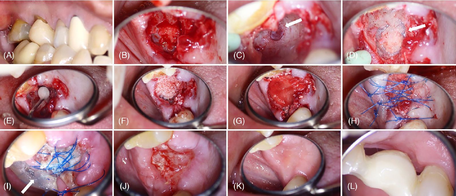 Предоперационный вид со щёчной стороны зуба 17