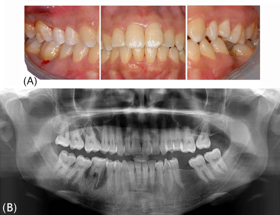(A) Вид в полости рта; (B) Панорамная рентгенограмма