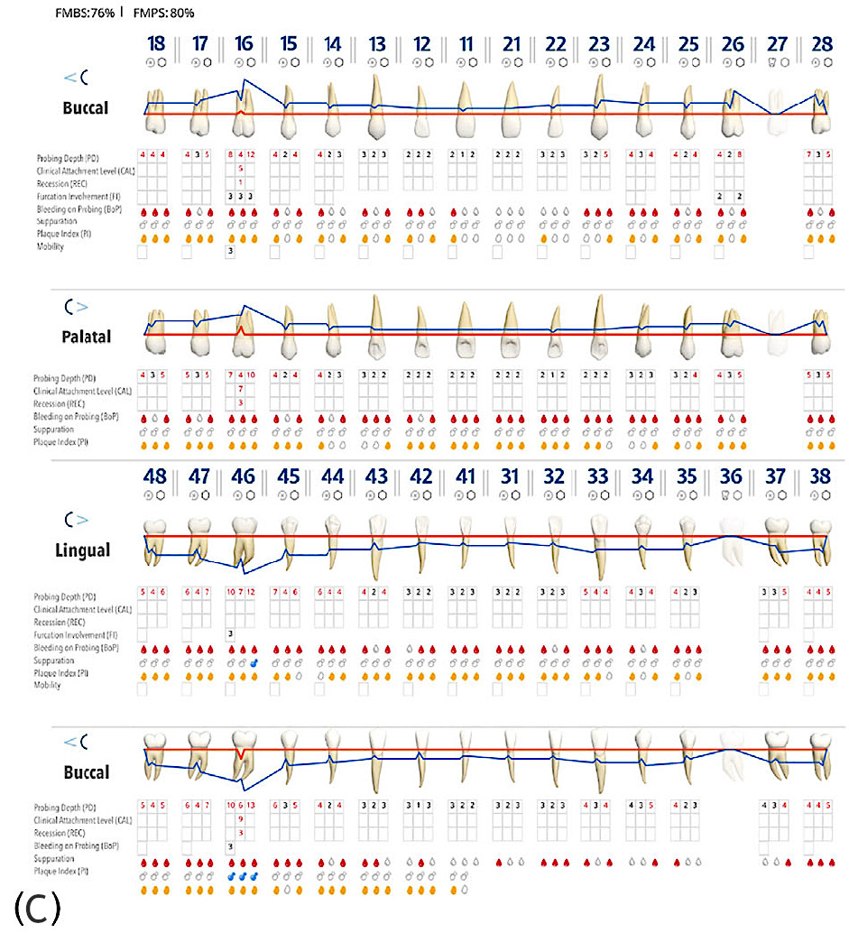 Полный пародонтальный статус (карта).
