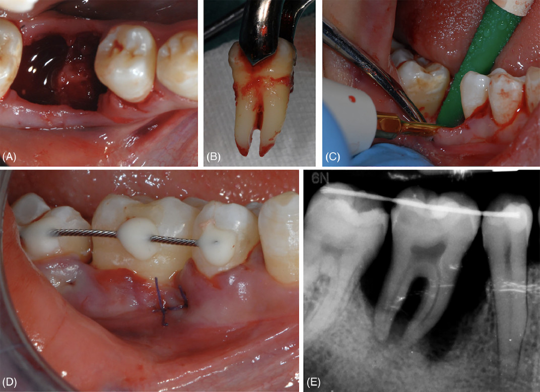 Лунка после удаления зуба 46