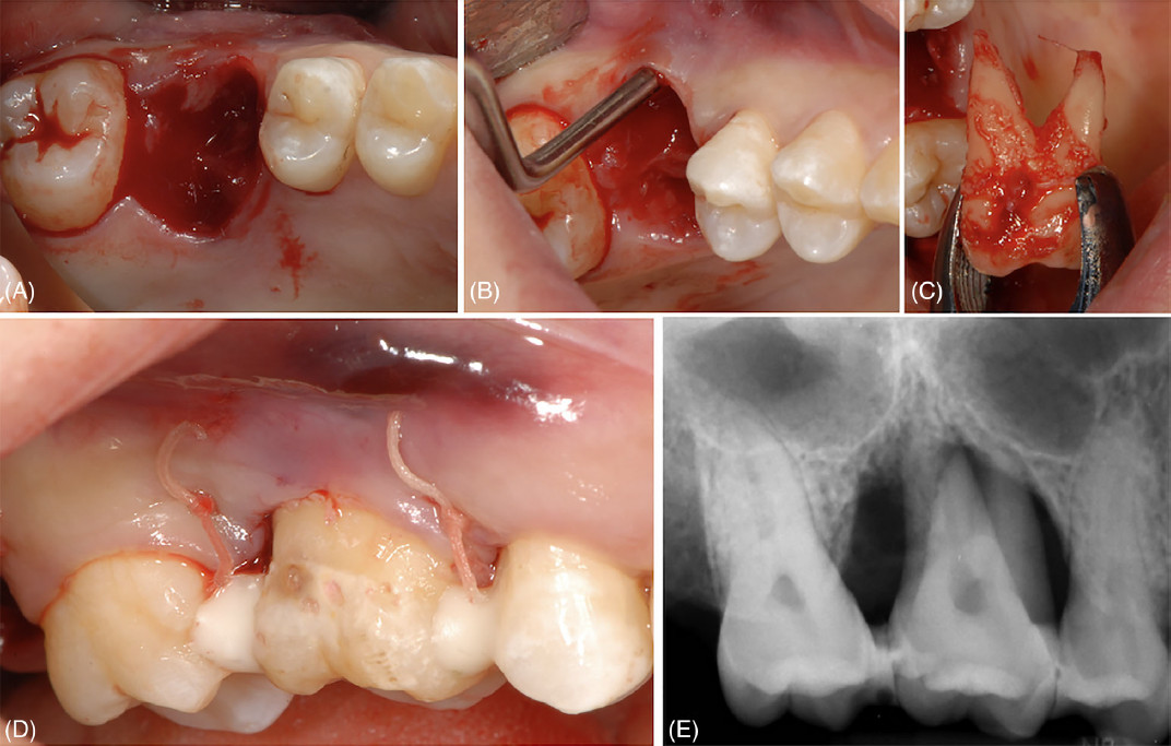 Лунка после удаления зуба 16