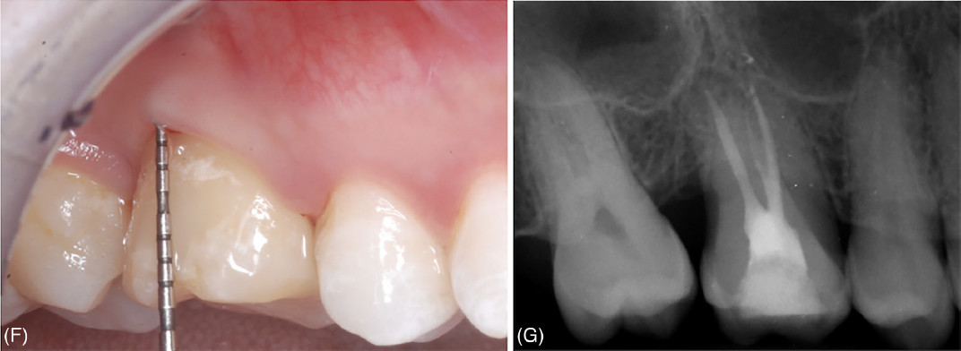 Клиническая картина через 24 месяца